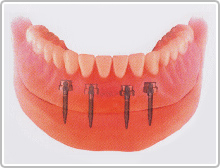 入れ歯安定剤のいらない下の総義歯