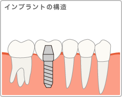 インプラントの構造