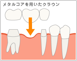 メタルコアを用いたクラウン