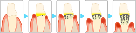 歯が動いてきたり、抜けてしまう過程