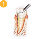 深い歯周ポケット、セメント質と歯根膜、歯槽骨の欠損