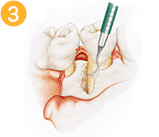 歯根面の徹底清掃