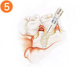 清掃した歯根面へのエムドゲイン溶液の塗布